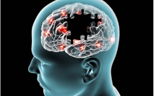 alzheimer